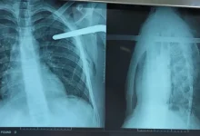 صورة صور صادمة.. إنقاذ مُراهق اخترقت قطعة حديدية صدره بمستشفى مصطفى باشا